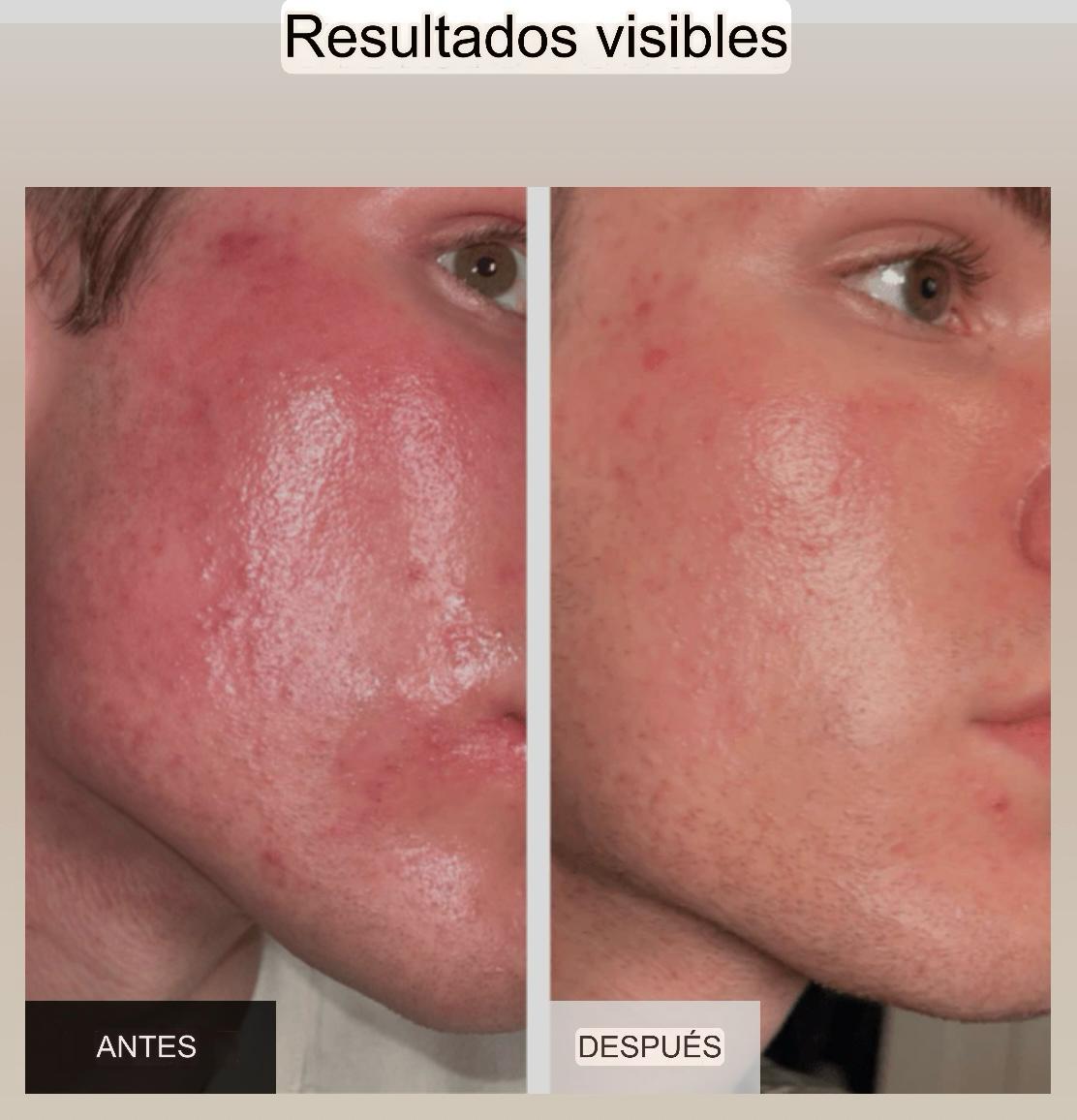 Mascarilla facial antiarrugas con terapia de luz (incluye mascarilla para el cuello GRATIS)