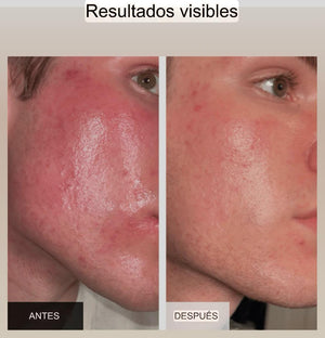 Mascarilla facial antiarrugas con terapia de luz (incluye mascarilla para el cuello GRATIS)